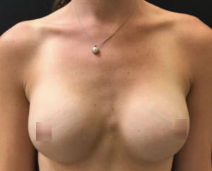 Breast Augmentation