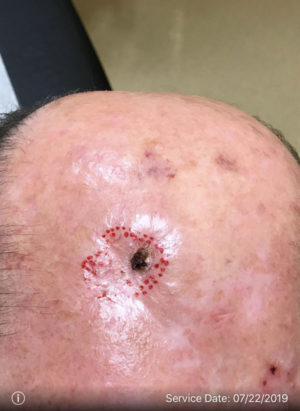 Basal Cell Carcinoma