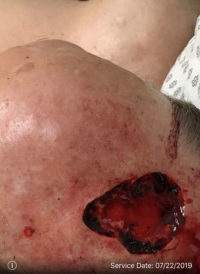 Basal Cell Carcinoma