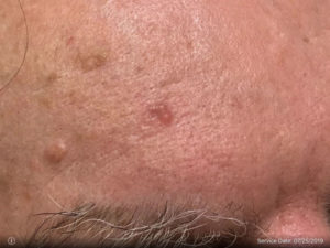 Basal Cell Carcinoma