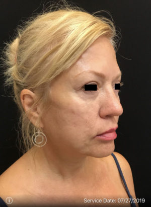 Around the eyes