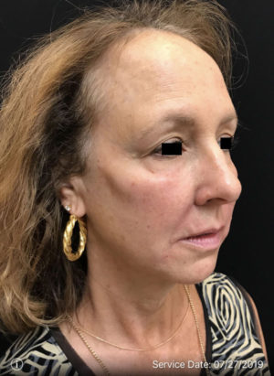 Around the eyes