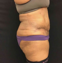 Tummy Tuck