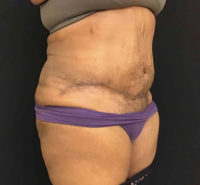 Tummy Tuck