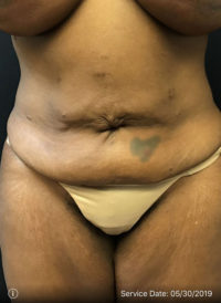 Tummy Tuck