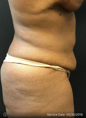 Tummy Tuck