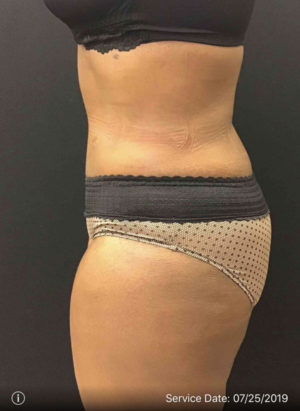 Tummy Tuck