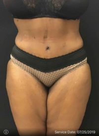 Tummy Tuck