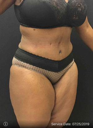 Tummy Tuck