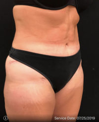 Tummy Tuck