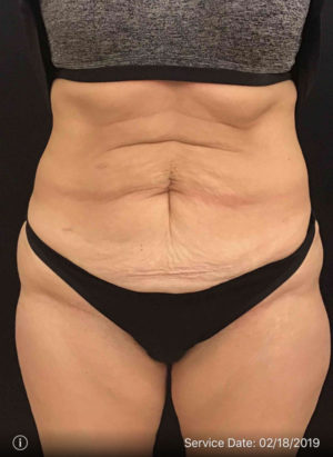 Tummy Tuck