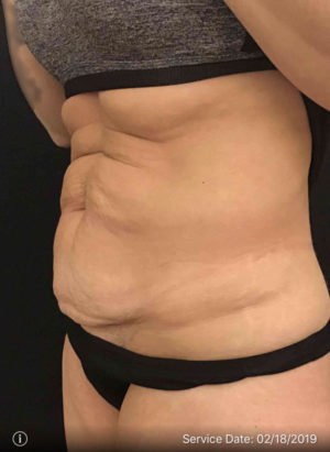 Tummy Tuck