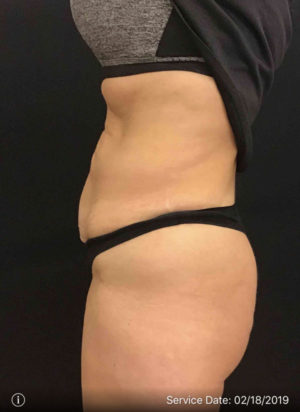 Tummy Tuck