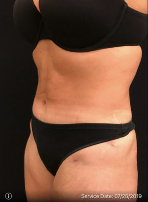 Tummy Tuck