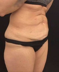 Tummy Tuck