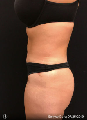 Tummy Tuck