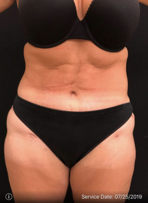 Tummy Tuck