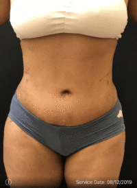 Tummy Tuck