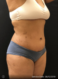 Tummy Tuck