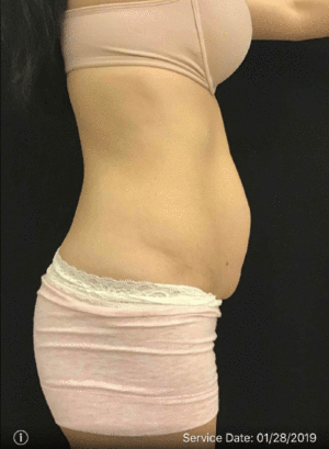 Tummy Tuck