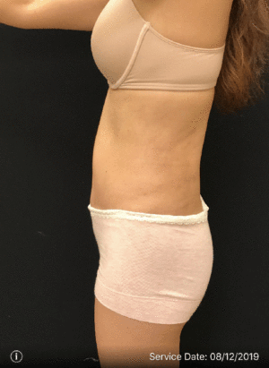 Tummy Tuck