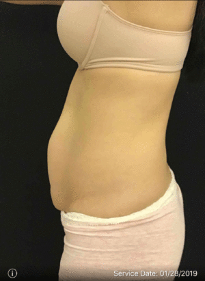 Tummy Tuck