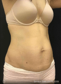 Tummy Tuck