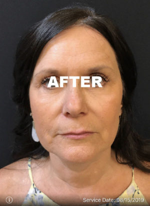 Botox Cosmetic/Dysport