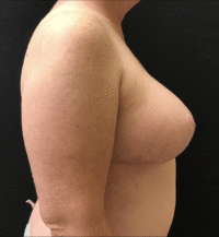 Breast Reduction