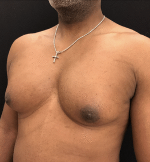 Gynecomastia