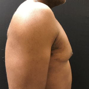 Gynecomastia