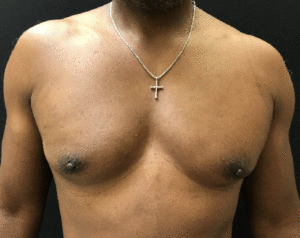 Gynecomastia