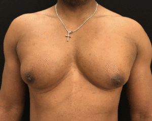 Gynecomastia