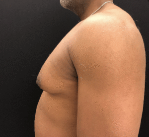 Gynecomastia