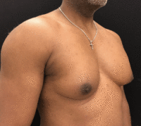 Gynecomastia