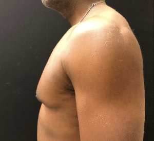 Gynecomastia