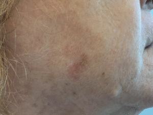 Malignant Melanoma