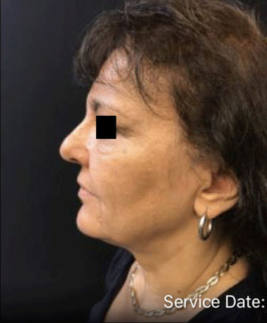 Nonsurgical Lift