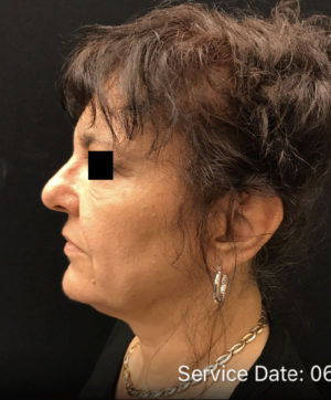 Nonsurgical Lift