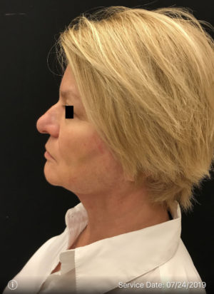 Nonsurgical Lift