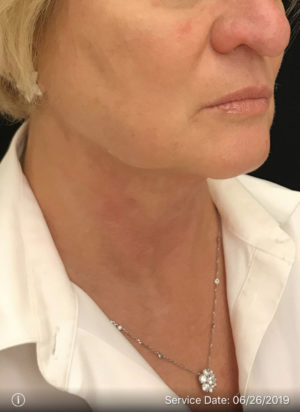 Nonsurgical Lift