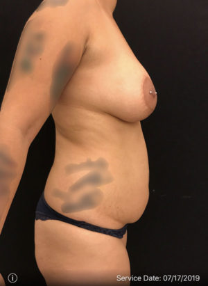 Tummy Tuck