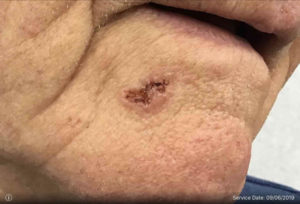 Basal Cell Carcinoma