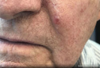 Basal Cell Carcinoma