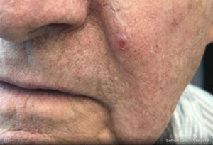 Basal Cell Carcinoma