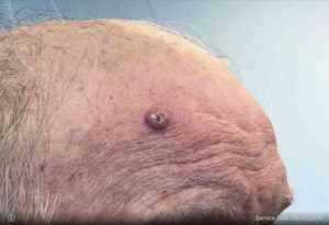 Squamous Cell Carcinoma