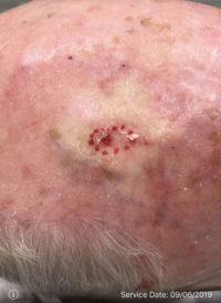 Squamous Cell Carcinoma