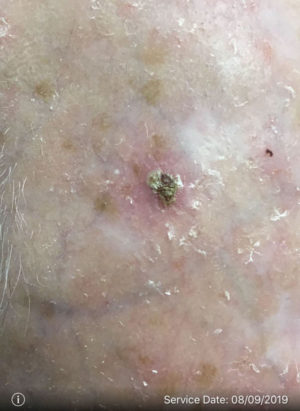 Squamous Cell Carcinoma