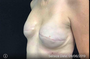 Breast Reduction