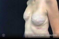 Breast Reduction
